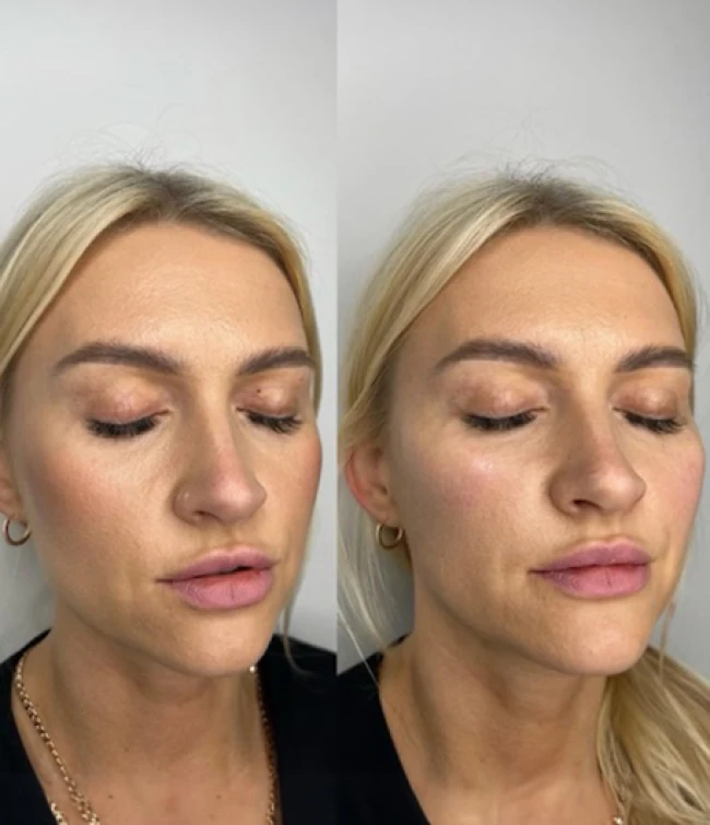 Hydroksyapatyt wapnia efekty