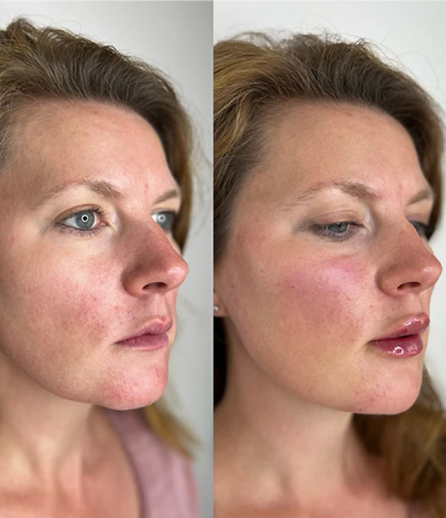 Twarz po zabiegu z użyciem hydroksyapatytu wapnia