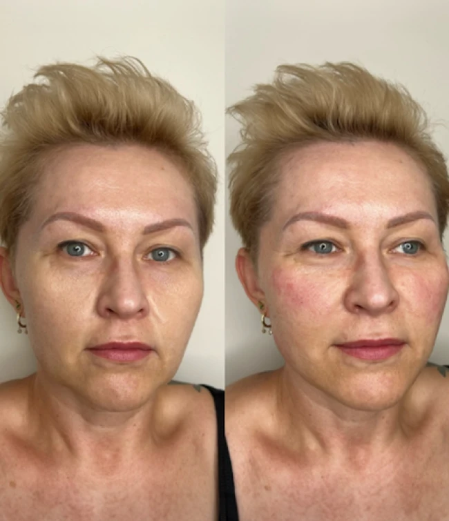 Hydroksyapatyt wapnia przed i po zabiegu