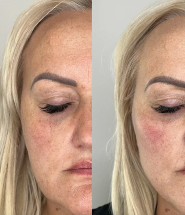 Efekty zabiegu zabiegu z użyciem hydroksyapatytu wapnia