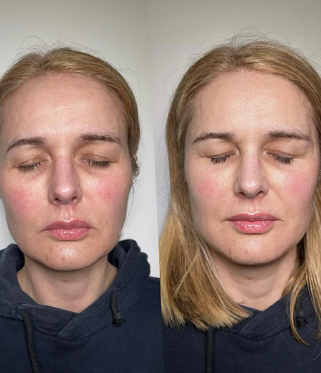 Efekty kwasu polimlekowego