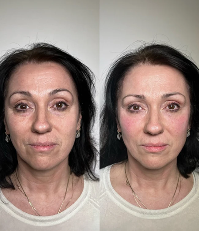 Twarz przed i po zastosowaniu kwasu polimlekowego