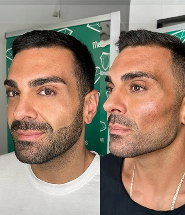 Twarz mężczyzny po zastosowaniu kwasu polimlekowego