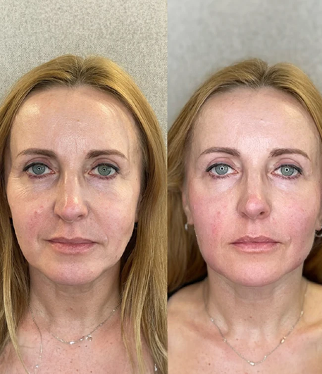 Kwas polimlekowy przed i po