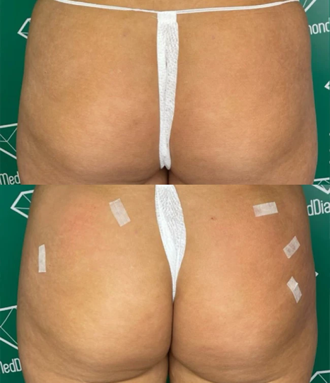 Przed i po modelowaniem pośladków