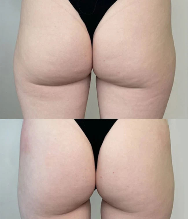 Efekty zabiegu modelowania ciała