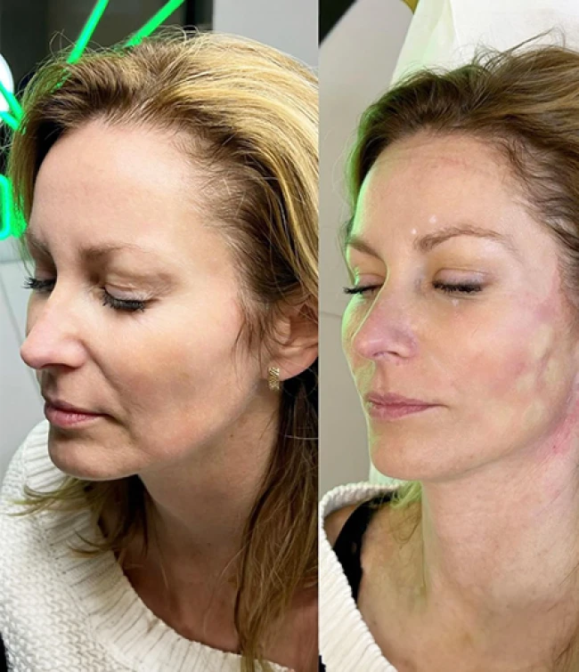 Kobieta przed i po zabiegu nićmi liftingujących