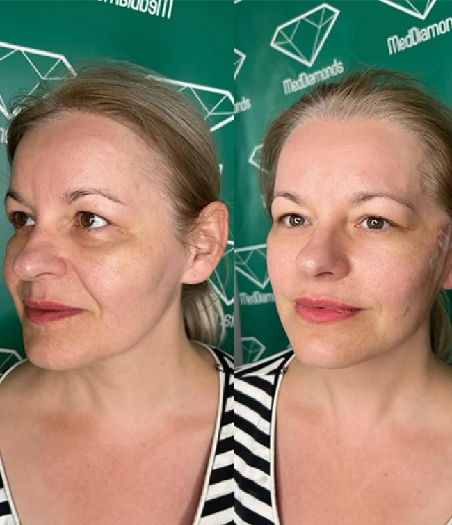 Efekty nici liftingujących