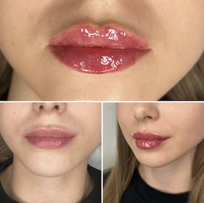 Przed i po powiększeniu ust