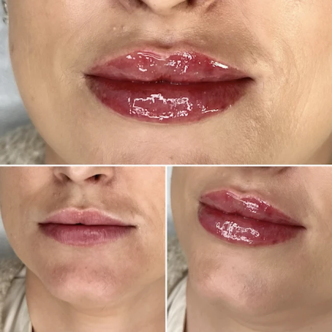 Przed i po zabiegu modelowania ust