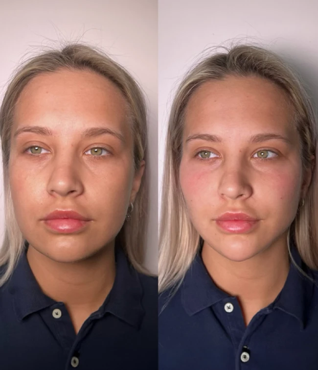 Kwas hialuronowy szkolenie