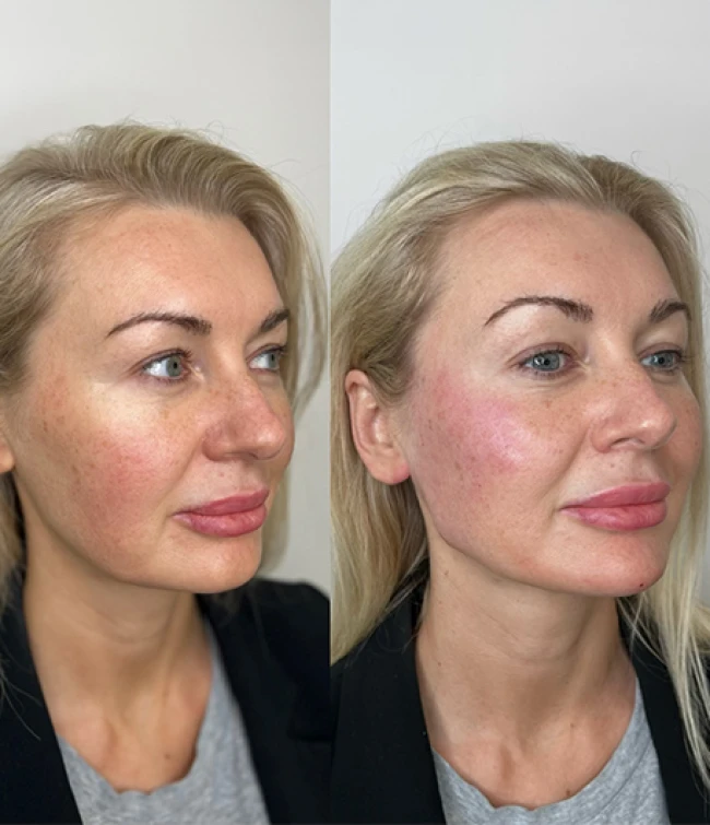 Kurs z ostrzykiwania kwasem hialuronowym