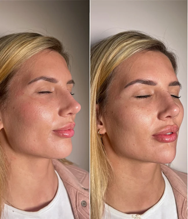 Zajęcia praktyczne w trakcie szkolenia z kwasu hialuronowego