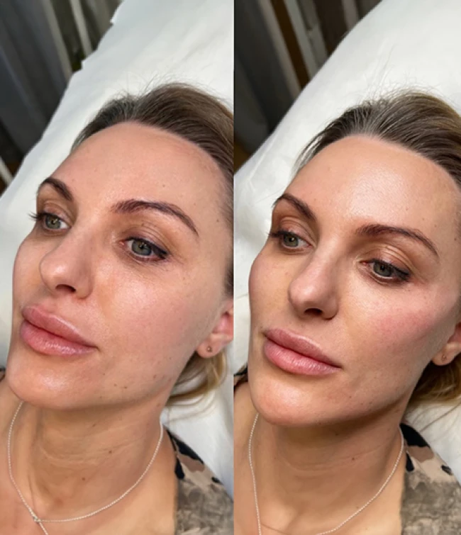 Wolumetria twarzy w Meddiamonds Warszawa