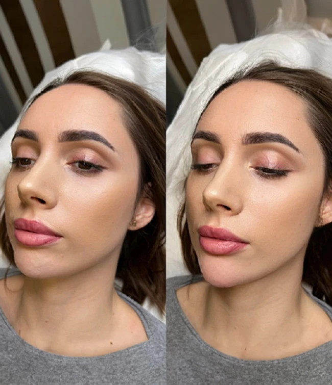 Efekty wolumetrii twarzy Meddiamonds Warszawa