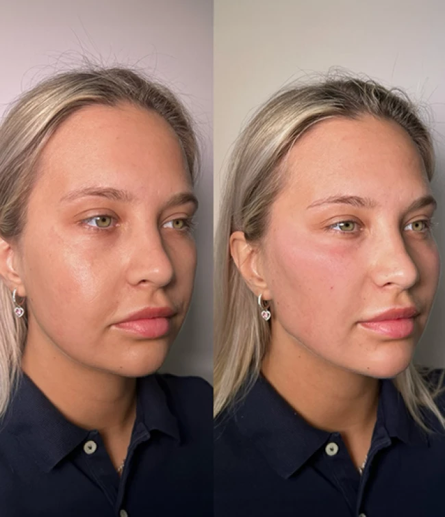 Wolumetria twarzy efekty zabiegu