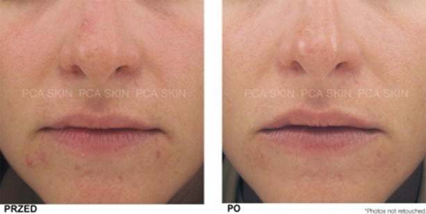 Efekty zabiegu OXYGENATING TRIO