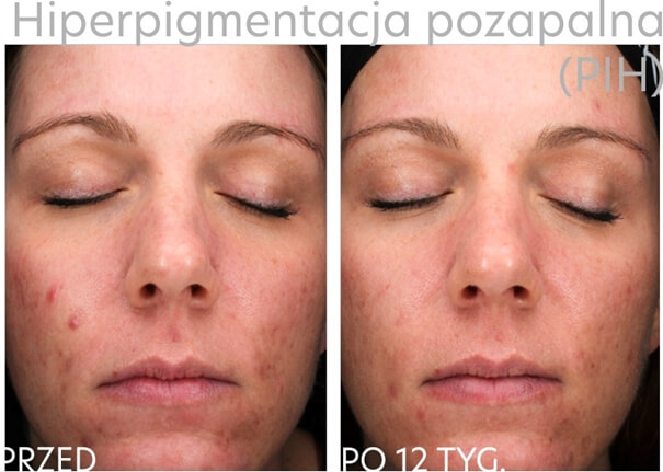 Hiperpigmentacja pozapalna