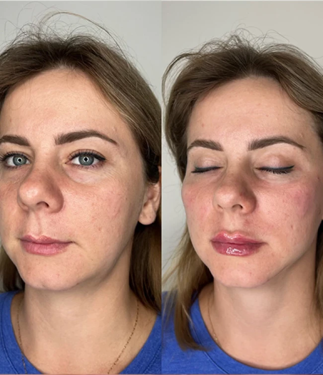 Modelka przed i po zabiegu wykonanego w ramach szkolenia hydroskapatyt wapnia