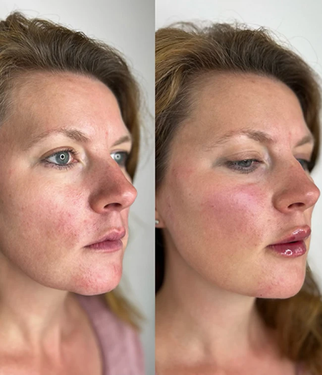 Modelka po wykonanym zabiegu Hydroskapatyt wapnia