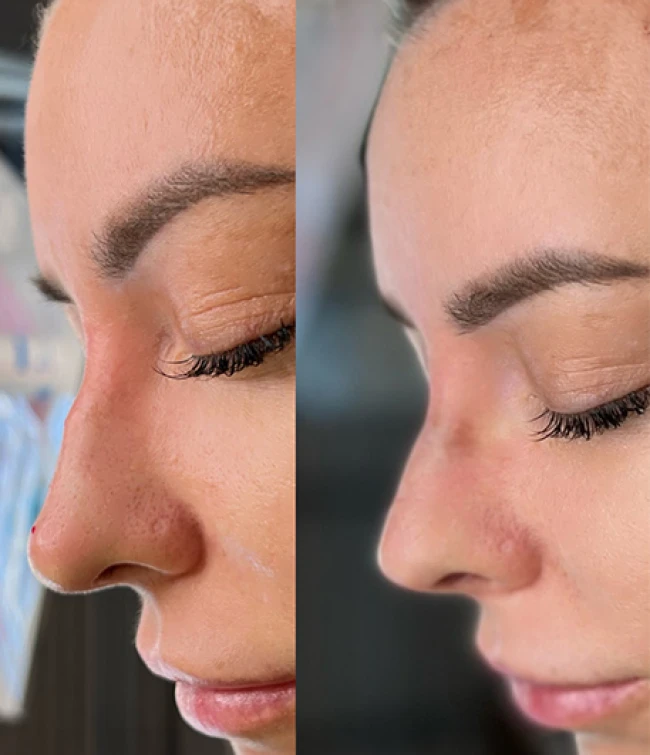 Kurs z nici liftingujących