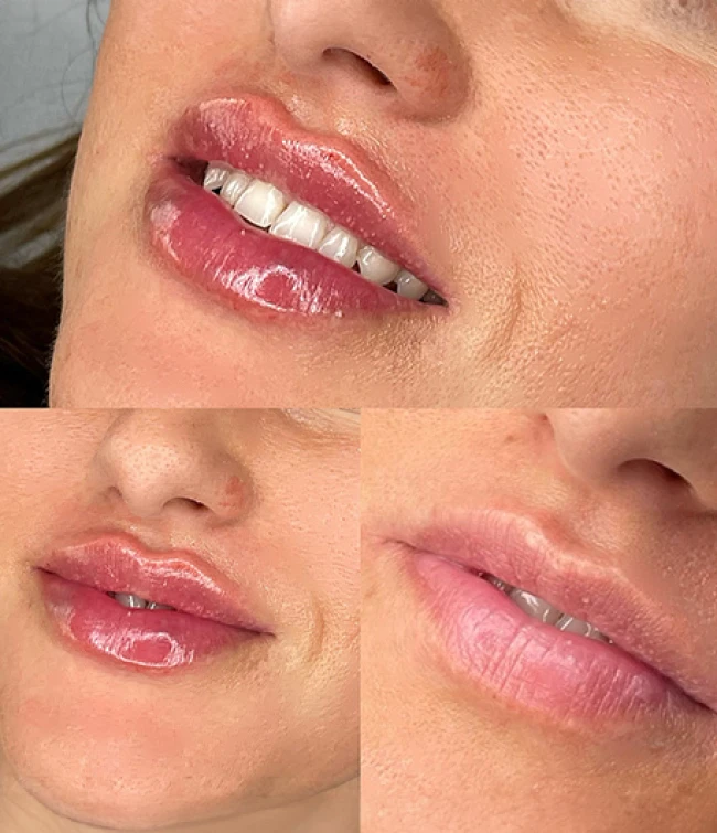 Efekty zabiegu powiększania ust wykonane przez uczestników szkolenia