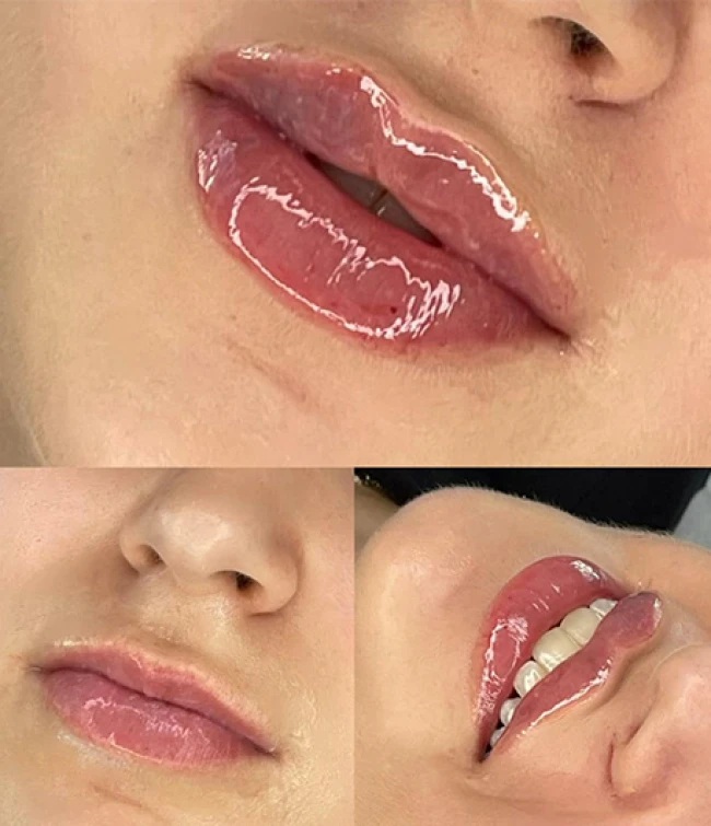 Modelka po wykonanym zabiegu powiększania i modelowania ust w trakcie szkolenia