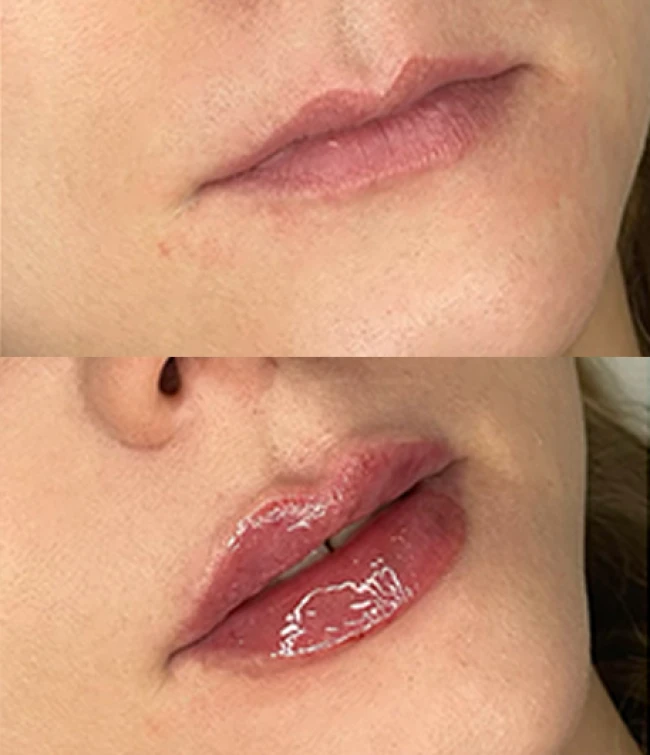 Zajęcia praktyczne powiększanie, modelowanie ust