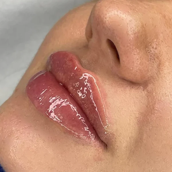 Szkolenie powiększanie i modelowanie ust – poziom MASTER CLASS